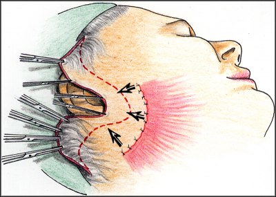 SMAS lifting a odstranění kožního nadby