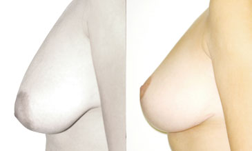 Modelace prsou 